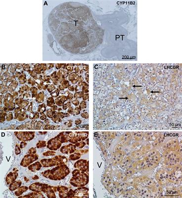 HCG-responsive aldosteronoma with transient secretion during pregnancy confirmed through HCG-stimulated adrenal venous sampling